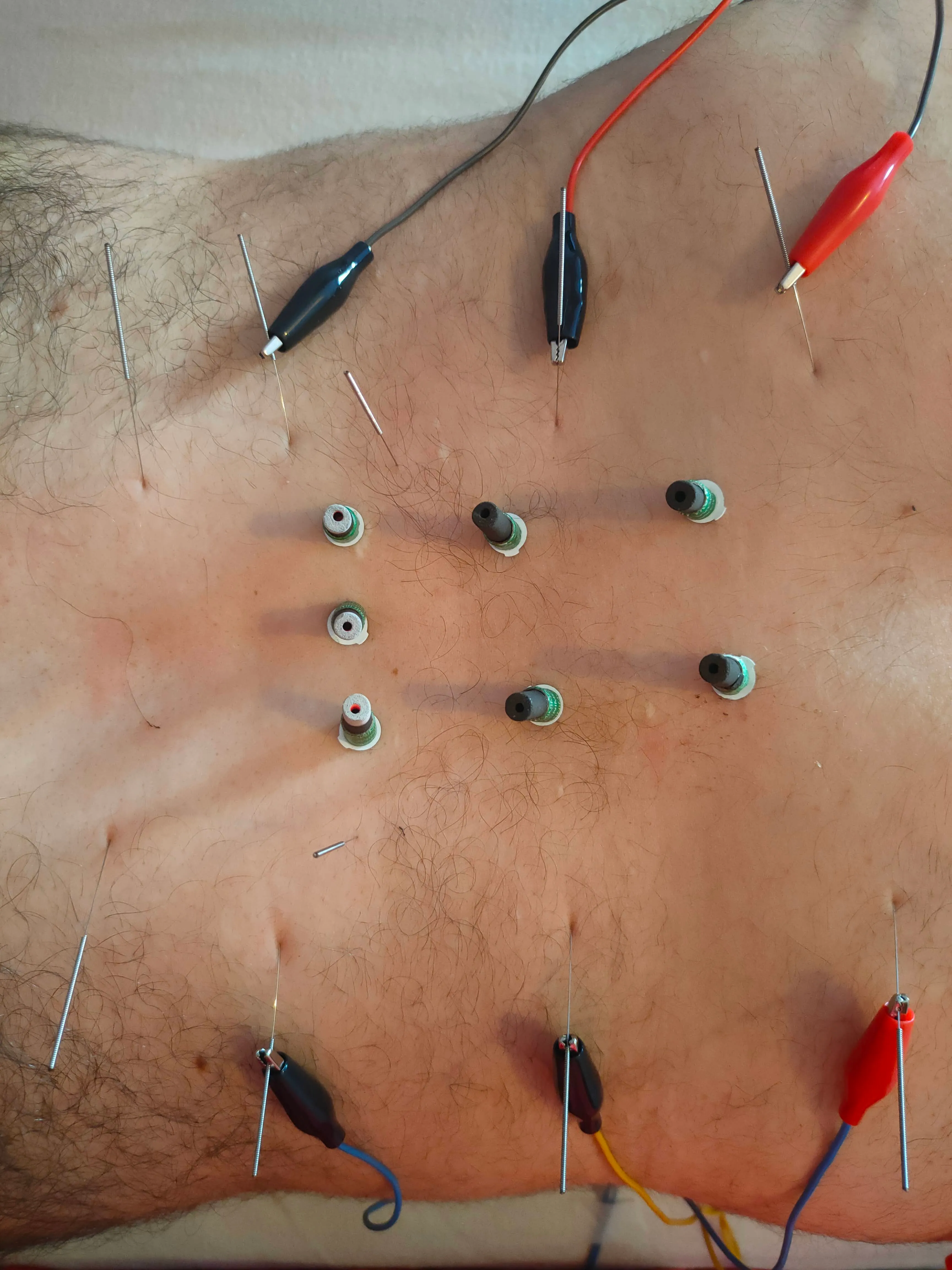 Moxa y acupuntura aplicadas en la espalda